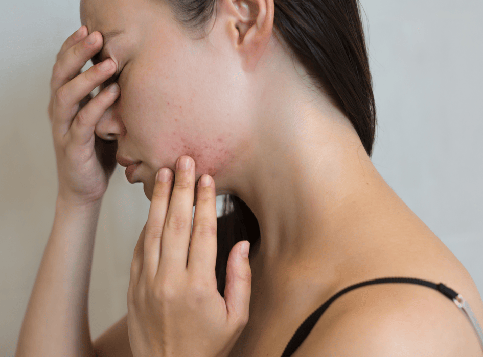 Ženska s problematično kožo in aknami