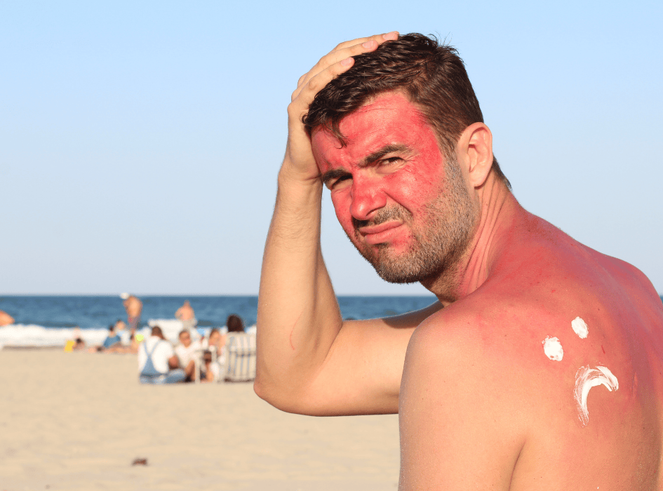muž na pláži má spálenou kůži a má úžeh-cz-alt