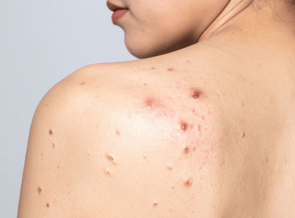 Problematická pleť, vyrážky na zádech