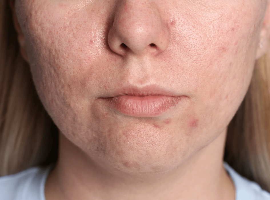Žena s problematickou pletí a akné