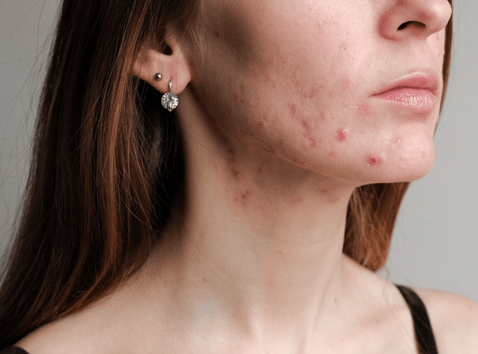 Mladá žena s aknóznou pleťou, so zápalovými vyrážkami na lícach, brade a sánke.