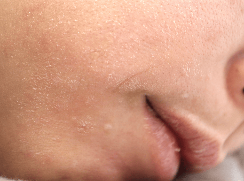 Ženska s suho kožo na obrazu