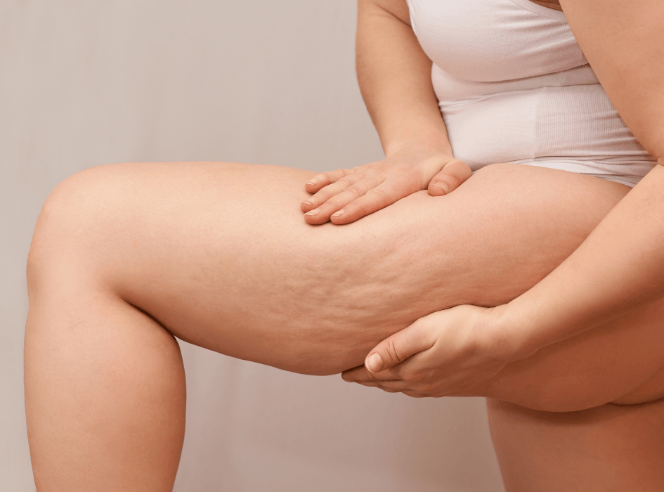 žena si drží stehno na kterém má celulitidu-cz-alt