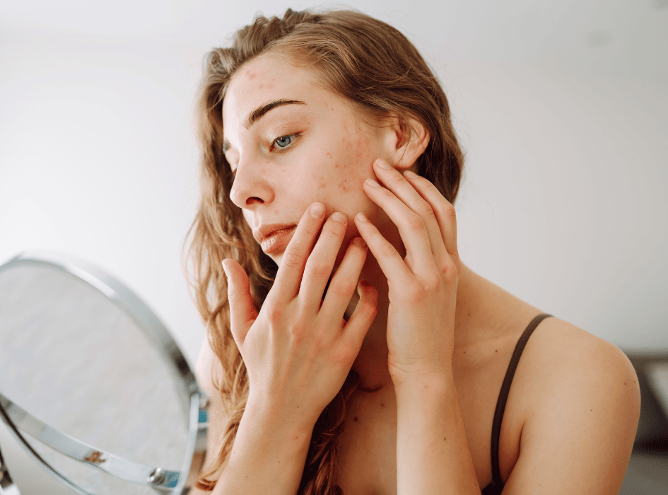 Žena, ktoré ma problémy s pleťou 