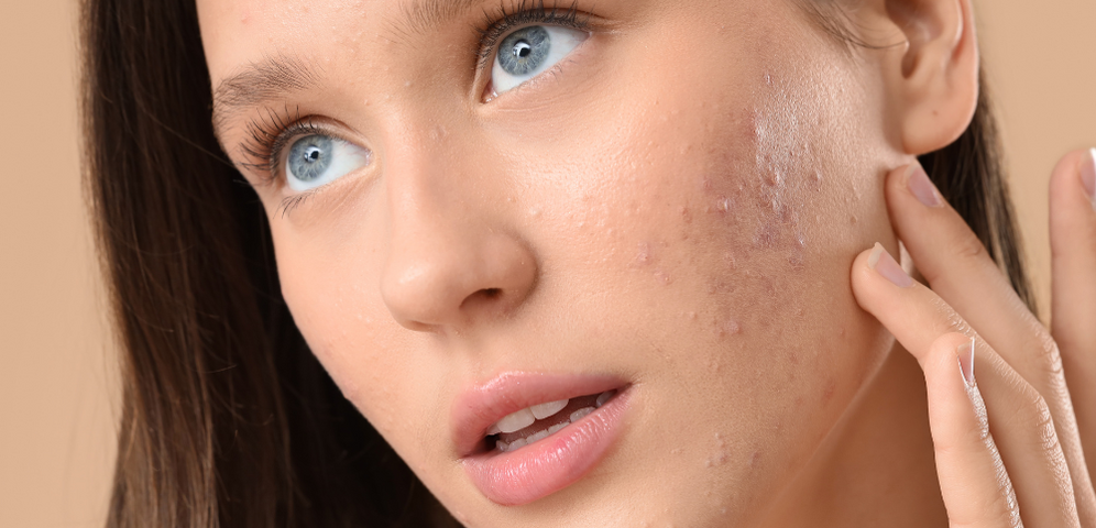 Probiotiká na akné: Objavte chýbajúci článok v liečbe vašej problematickej pleti