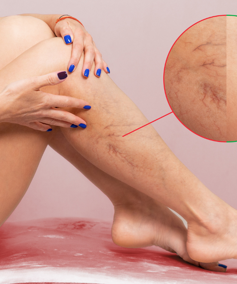 Dlaczego powstają żylaki i jak im zapobiegać?