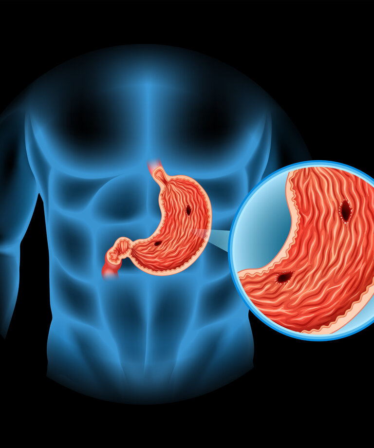 Vitamin U - vynikající na žaludeční vředy