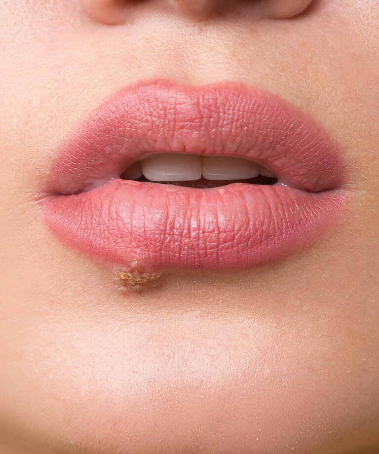 Esencialna aminokislina L-lizin - odlična za herpes.