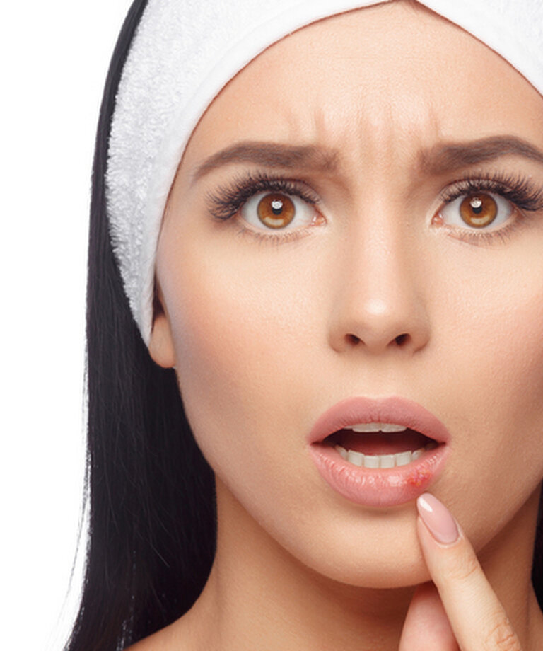 Nepríjemné vírusové ochorenie - Herpes