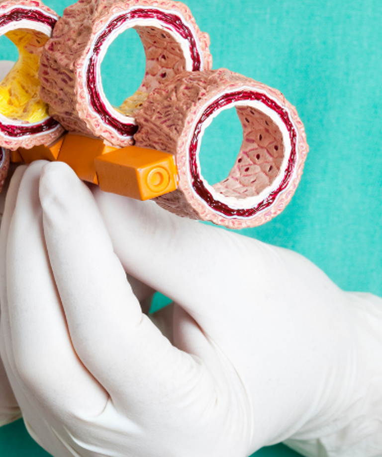 Miażdżyca - choroba naczyń krwionośnych