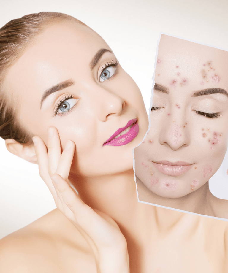 Prečo vzniká akné, aká liečba je účinná a akým chybám sa vyhnúť?