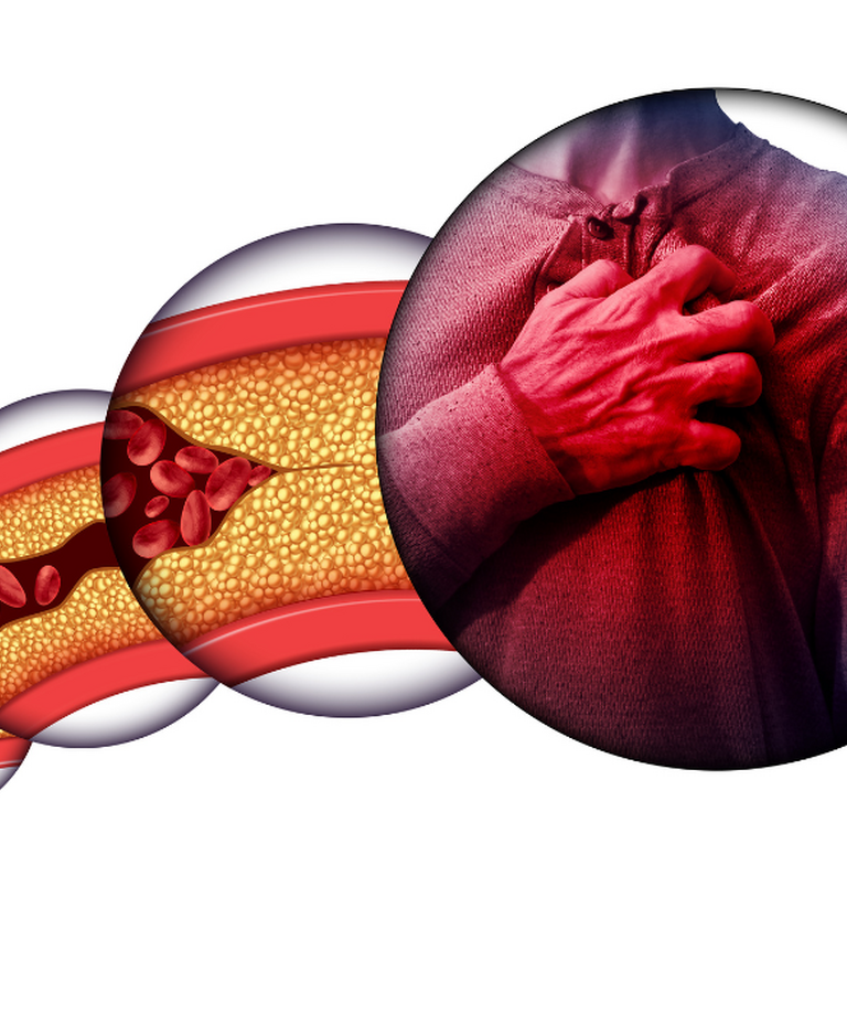 Jaké jsou nejčastější příčiny civilizačních onemocnění srdečně-cévního systému a jak s nimi bojovat?