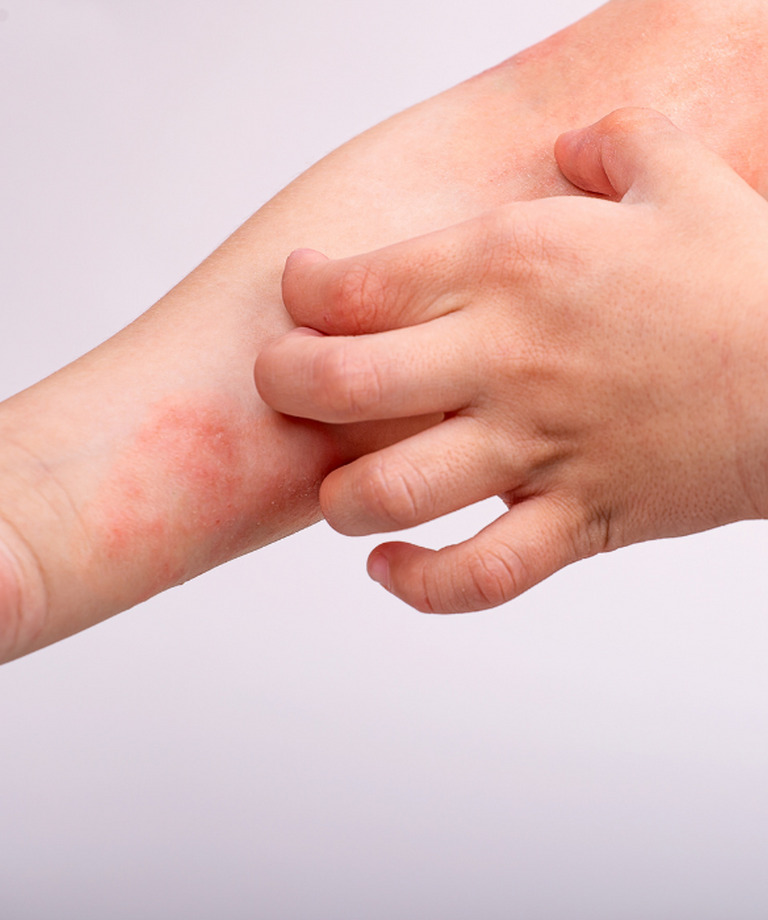 Rola probiotyków w zapobieganiu alergii u dzieci