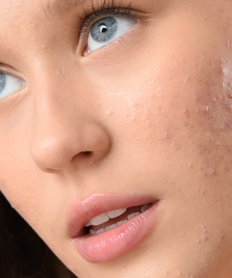 Probiotiki za akne: Odkrijte manjkajoči člen pri zdravljenju vaše problematične kože